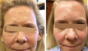 Botox injections removed woman's forehead wrinkles