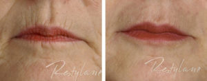 Woman who had lip lines filled in with Restylane