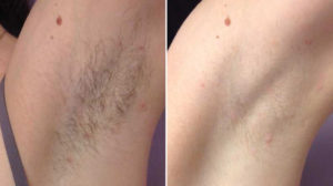 Laser Hair removal for underarm hair