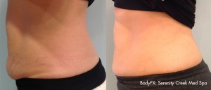 Forma Plus Skin Tightening Before After College Station TX