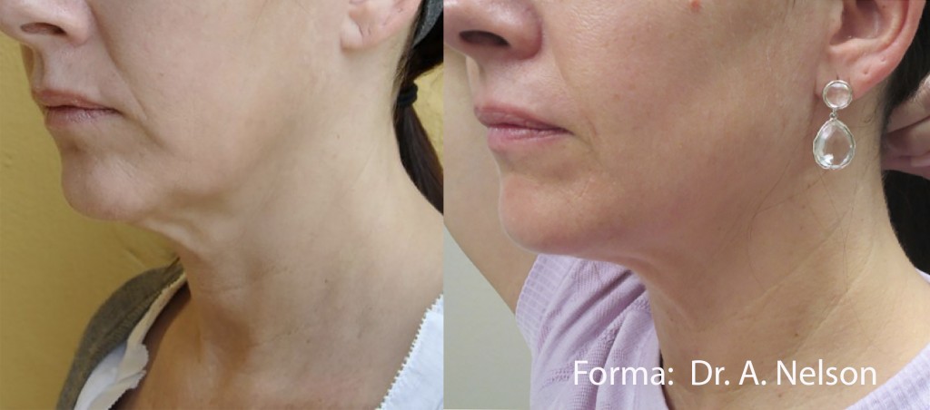 Forma Neck Skin Tightening Before After