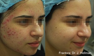 Woman with decreased acne scarring after Fractora
