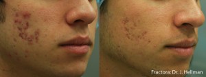 Fractora Acne Before After College Station TX