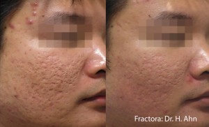 Man with decreased acne scarring after Fractora