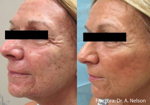 Fractora Skin Rejuvenation Before After