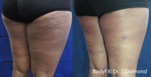 Woman with cellulite free legs after BodyFX