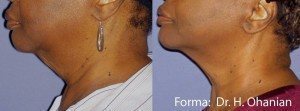 Woman with less submental fat after Forma treatment