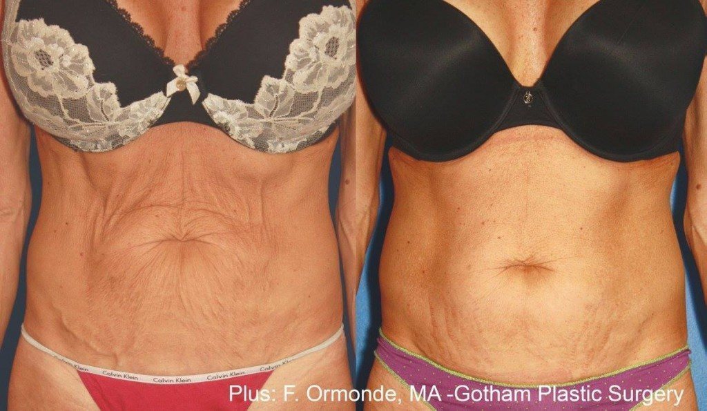 Woman with tight abdominal skin after treatment