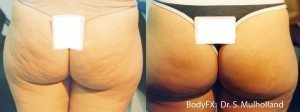 Woman with cellulite free buttocks after BodyFX