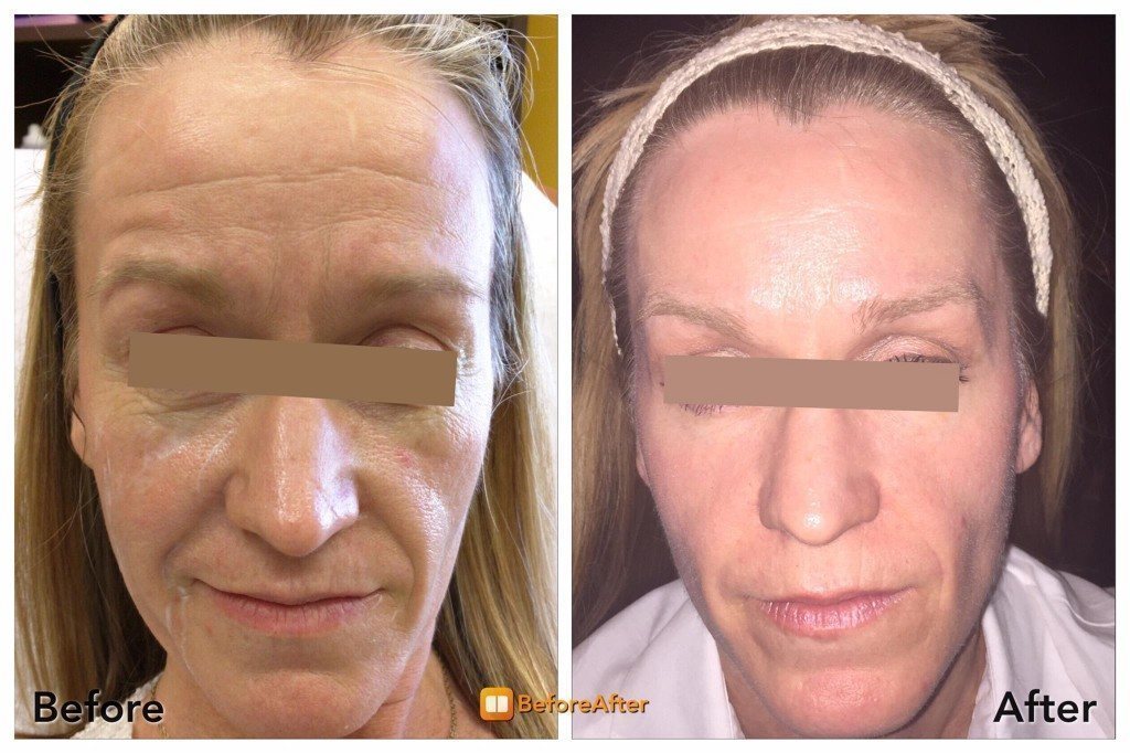 Woman with clear complexion after PRP treatment