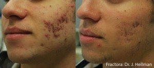 Before and After image of man who had acne scars