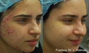 Before and After image of woman who had acne scars