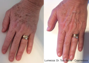 Beautiful hands after PRP Regenerative Hand Therapy