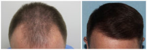 Man with full head of hair after SmartGraft™