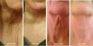 Woman's neck before and after Instatox