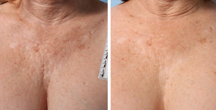 Woman with reduced wrinkles after treatment