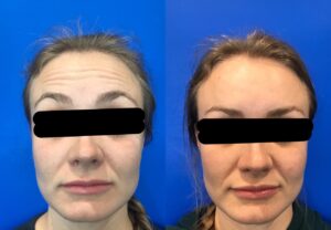 Woman's face before and after Artox results