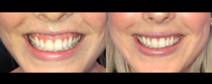 Woman's smile before and after Artox for gummy smile
