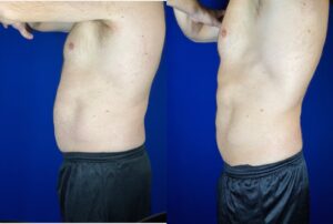 Man's abdomen before and after body contouring