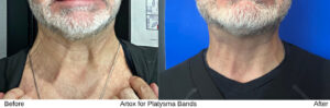 Before and after Artox for Platysma Bands