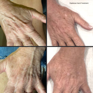 Hands before and after Radiesse hand treatment
