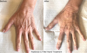 Hands before and after Radiesse and hand filler